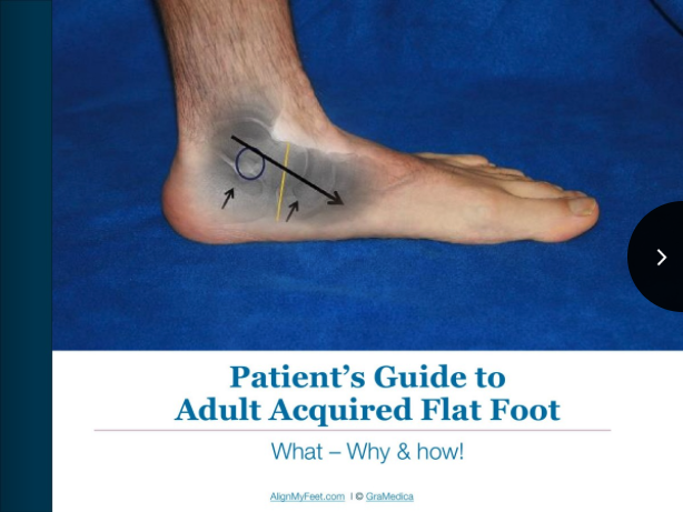 Adult Acquired Flat Foot | HyProCure 