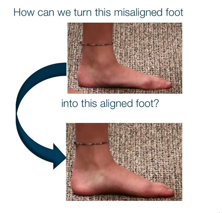 Realignment & Stabilization of the Ankle Bone