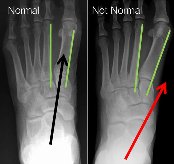 top to bottom view x-rays of an aligned and misaligned ankle bone