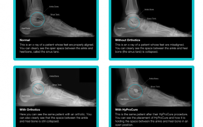 Do Orthotics Work for the Treatment of Plantar Heel Pain?
