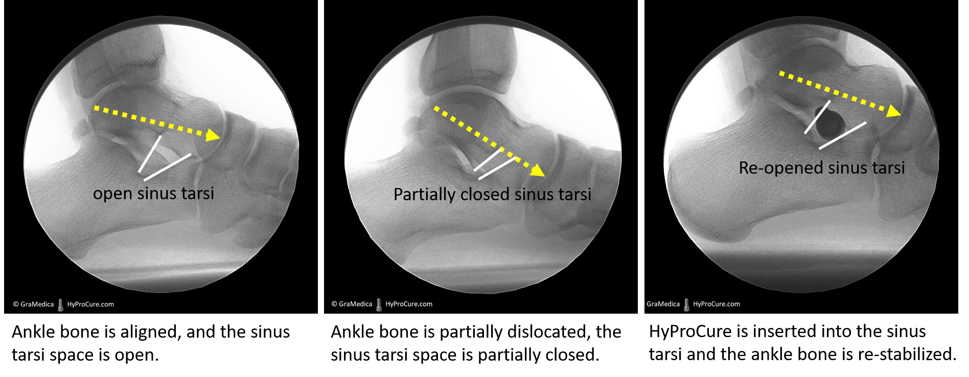 x-ray of the HyProCure implant placed in sinus tarsi space