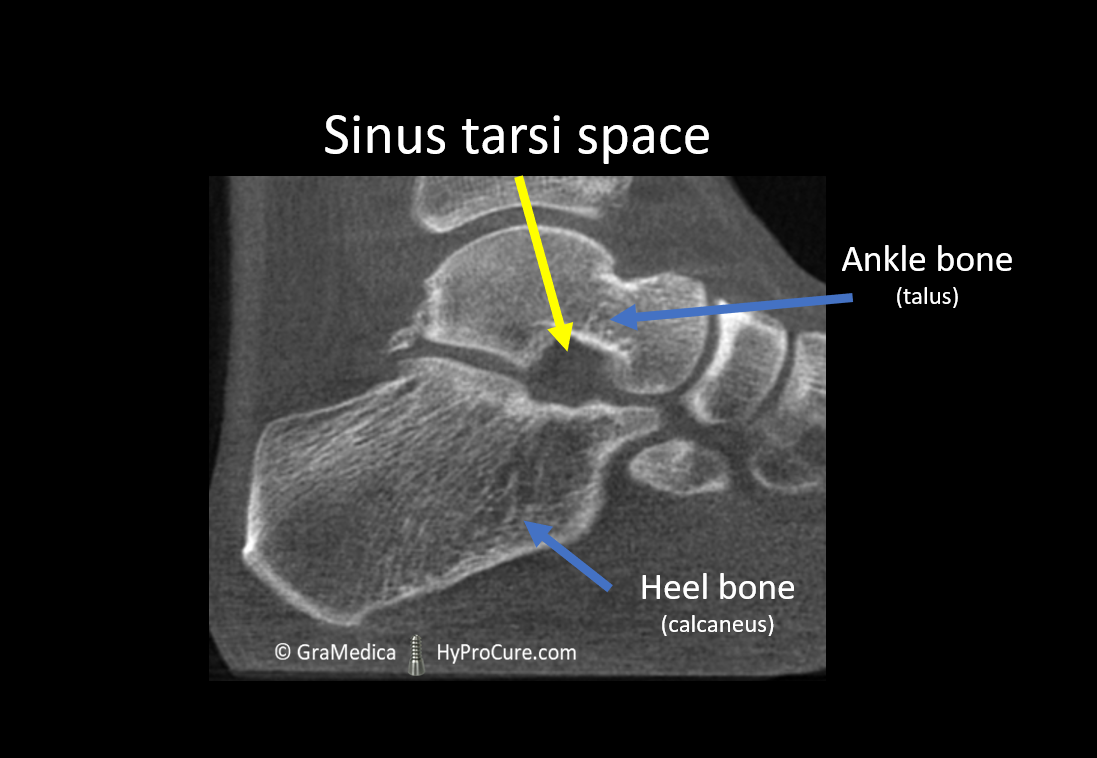 open sinus tarsi space