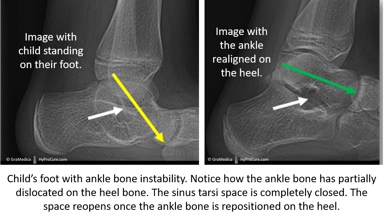 Child's foot with ankle bone instability