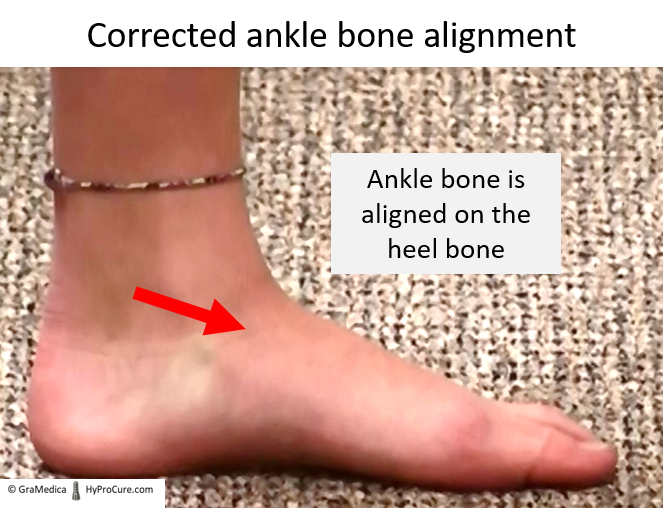 Corrected ankle bone alignment