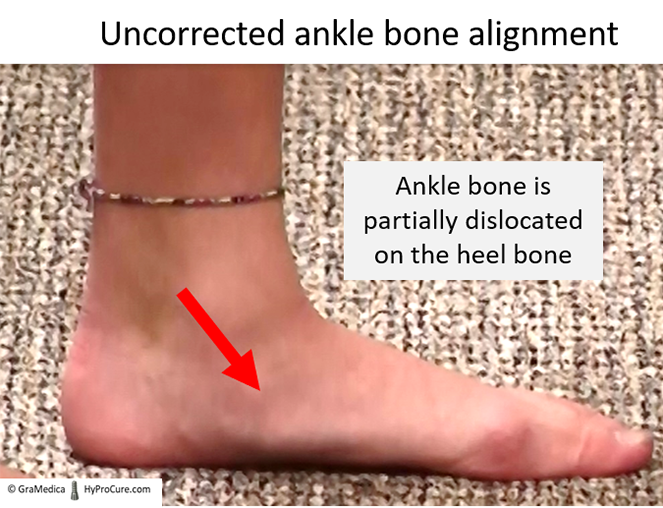 Uncorrected ankle bone alignment