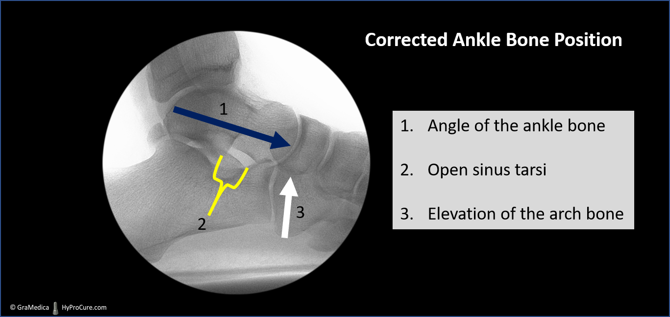 Side foot standing x-ray - corrected ankle bone position
