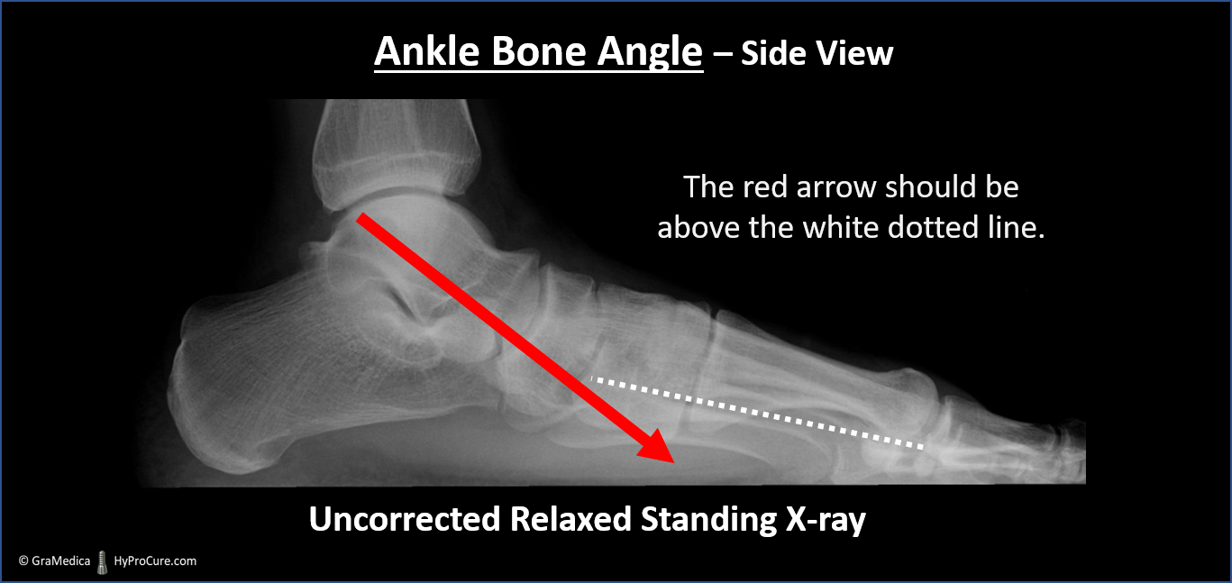 Side view standing X-ray of uncorrected relaxed Ankle Bone