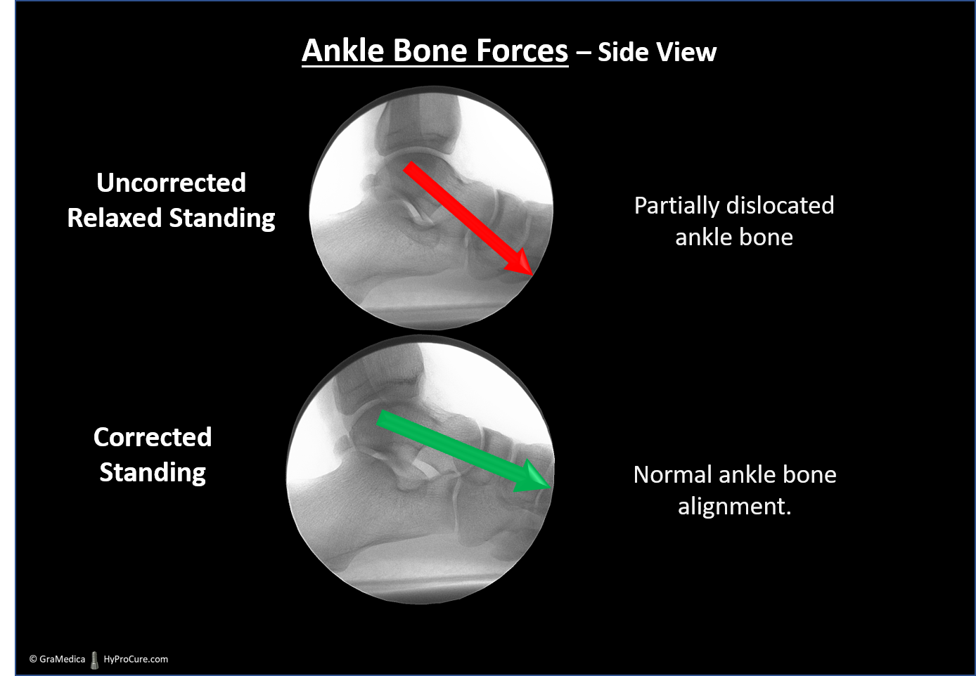 Side view x-ray showing difference between a stable and aligned ankle bone compared to a partially dislocated ankle bone