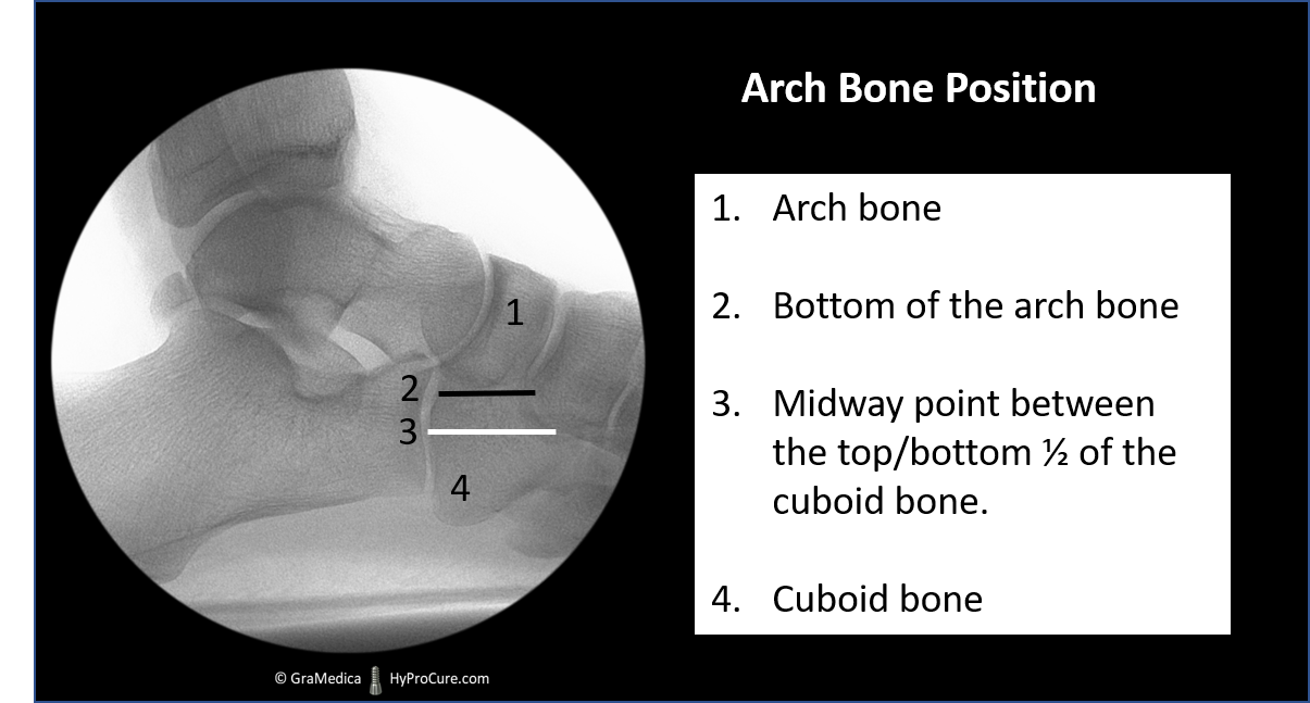 Arch bone position