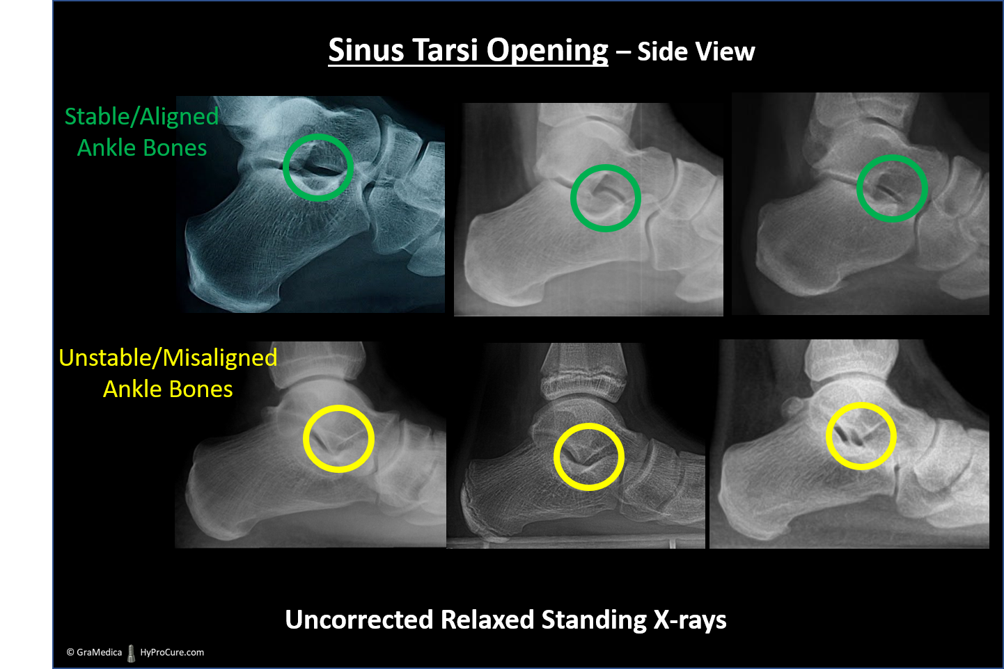 Side view x-ray showing Sinus Tarsi Space of stable ankle bones compared to a unstable ankle bones