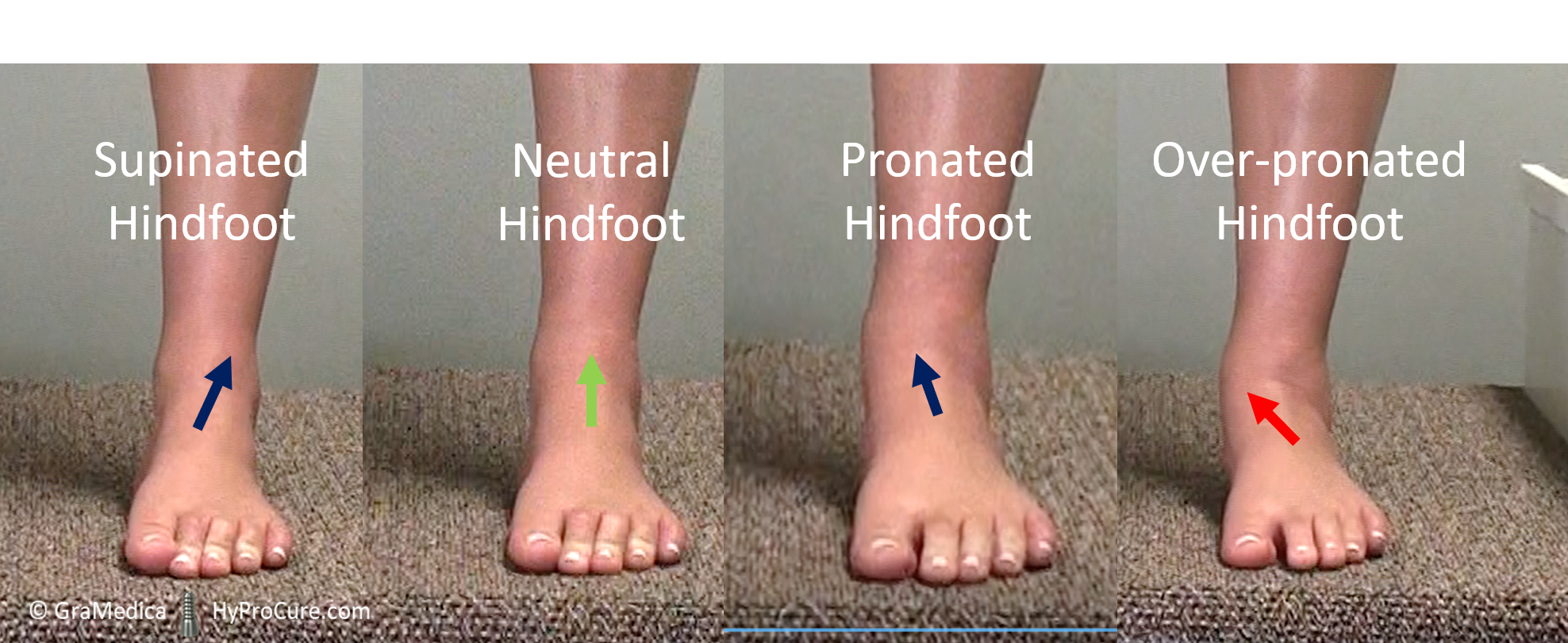 Supinated hindfoot neutral hindfoot pronated hindfoot over-pronated hindfoot