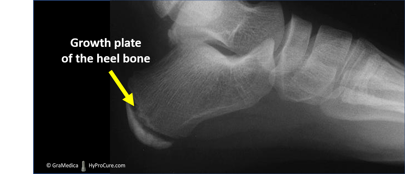 Growth plate of the heel bone