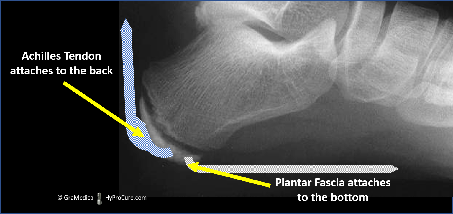 Over-pronation of the foot is named as the leading cause of inflammation of the growth plate of the heel 