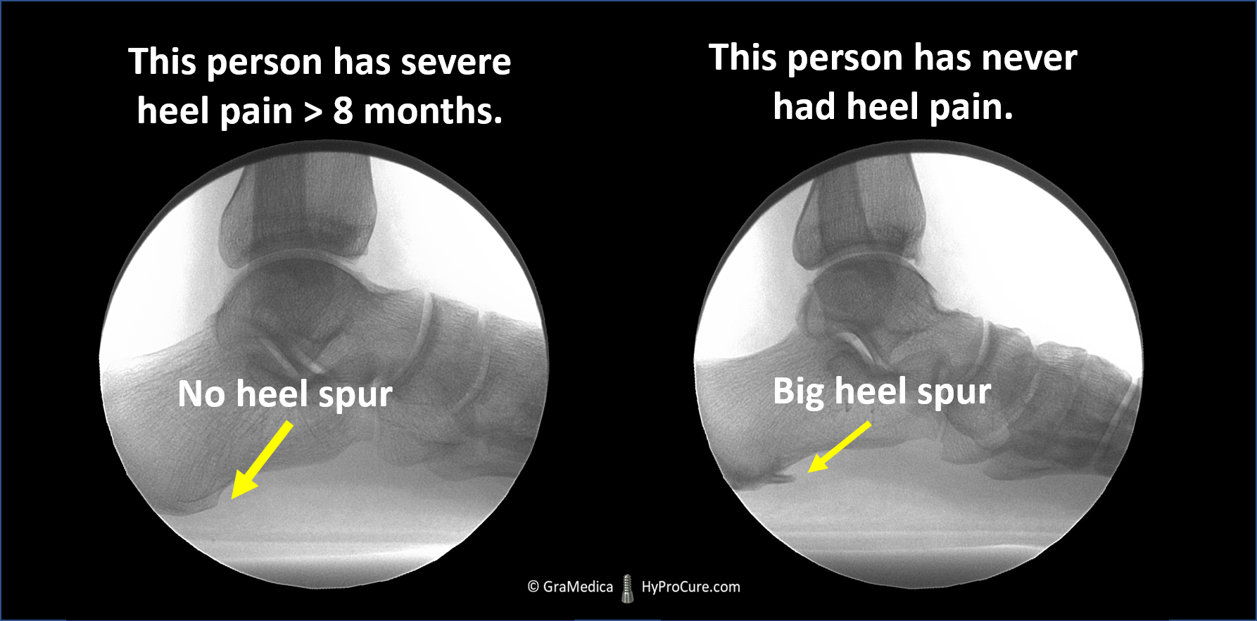 Foot x-ray showing no heel spur and big heel spur