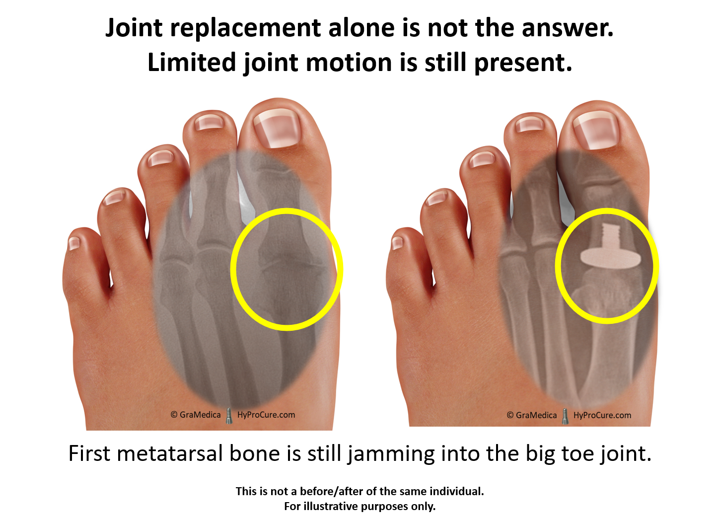 Big Toe Joint Pain Limitedpainful Motion Hyprocure The Proven