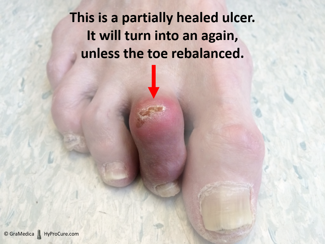 foot with advanced hammertoes and a partially healed ulcer