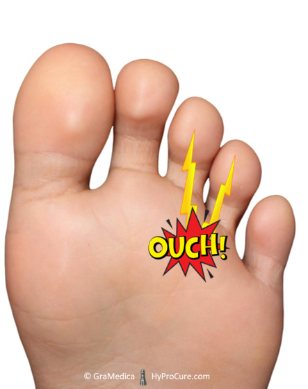 Foot with painful condition - Morton’s Neuroma