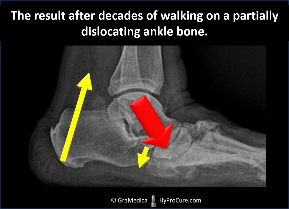 The results after decades of walking on a partially dislocating ankle bone