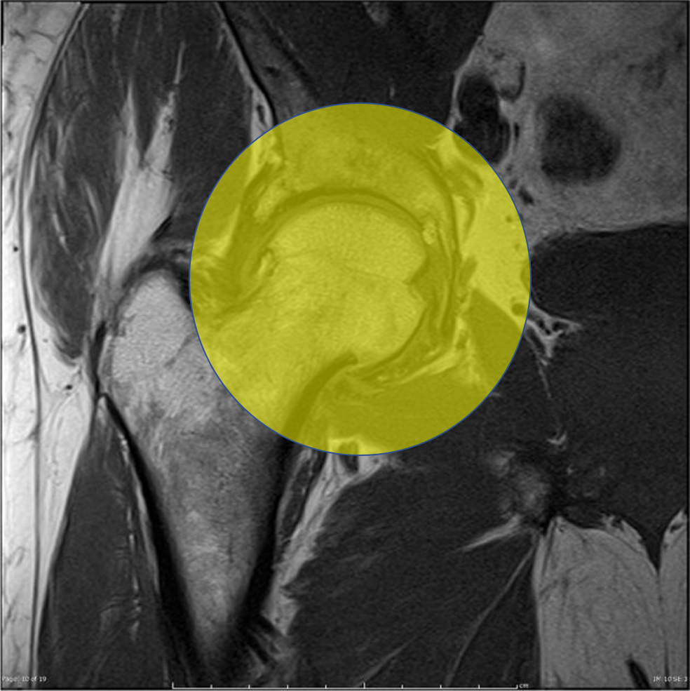 Radiographic image Hip-to-pelvis bone alignment