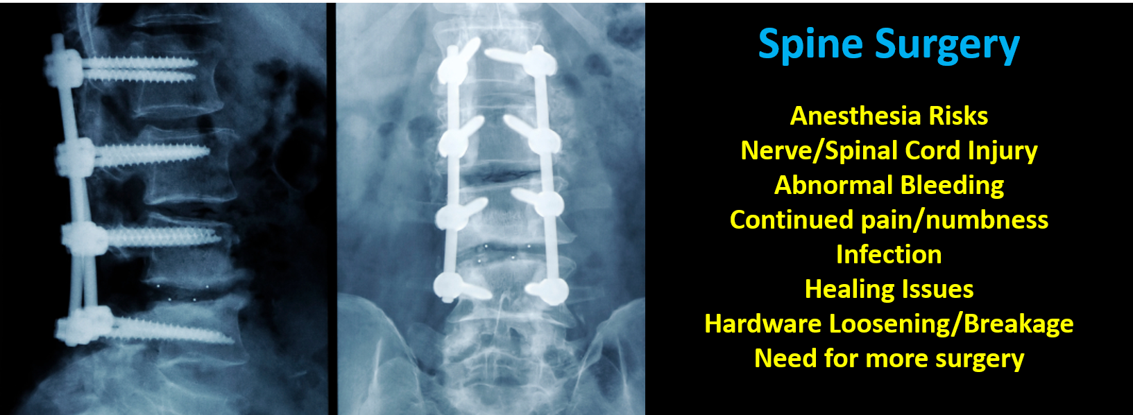 X-ray of spine surgery