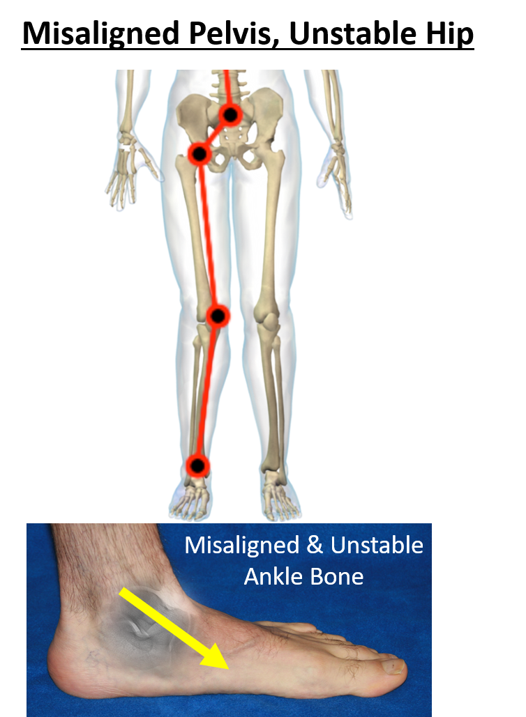 misaligned pelvis, unstable hip