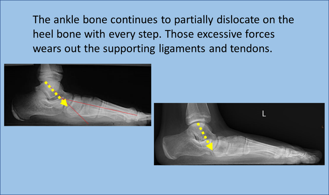The ankle bone continues to partially dislocate on the heel bone with every step.
