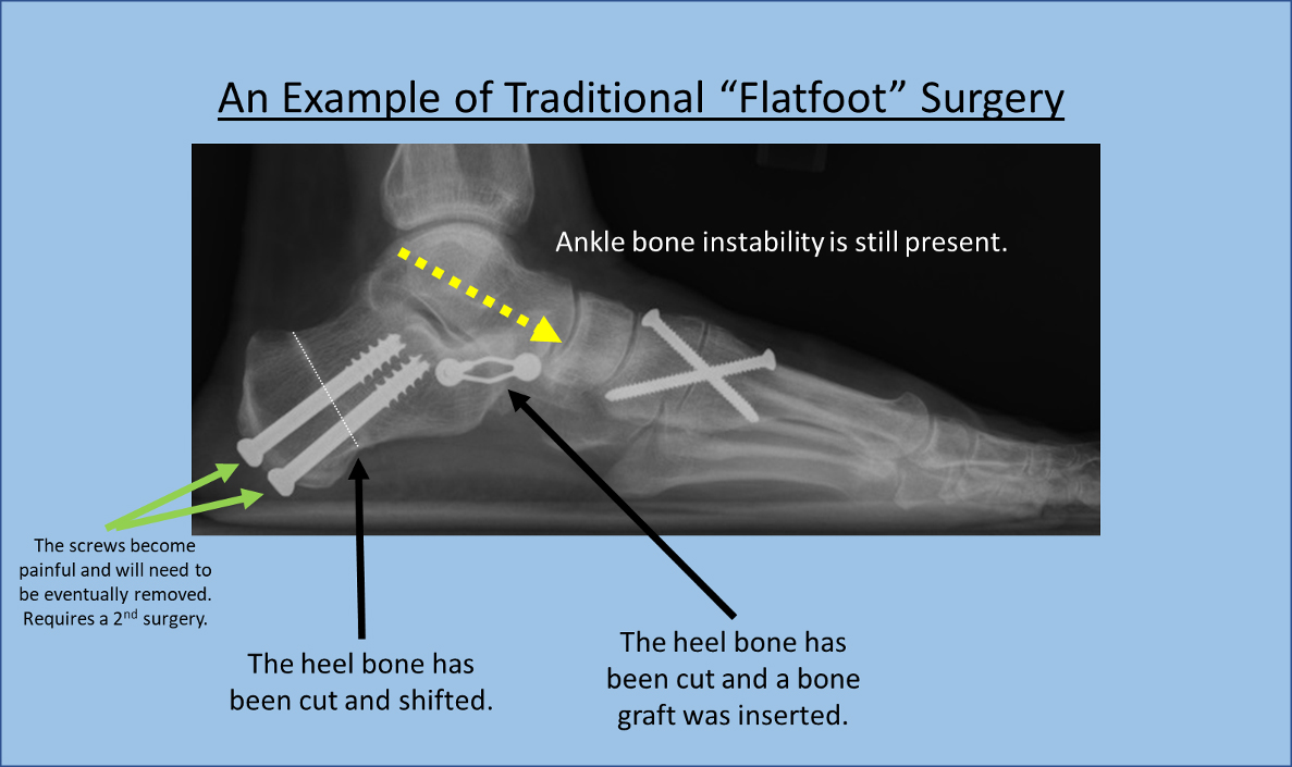An Example of Traditional "Flatfoot" surgery