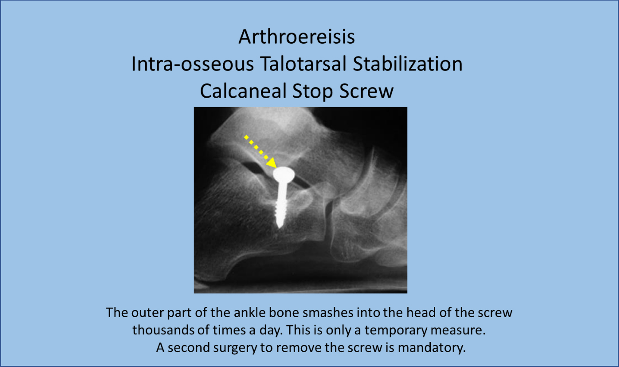 Arthroereisis Intra-osseous talotarsal stabilization calcaneal stop screw