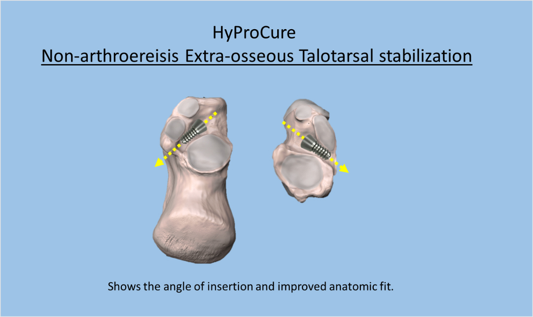HyProCure Non-arthroereisis extra-osseous talotarsal stabilization