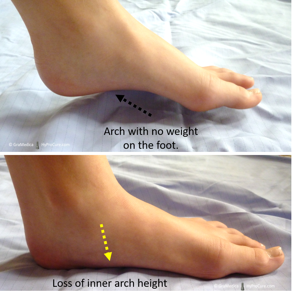 How do I know if my child has misaligned feet